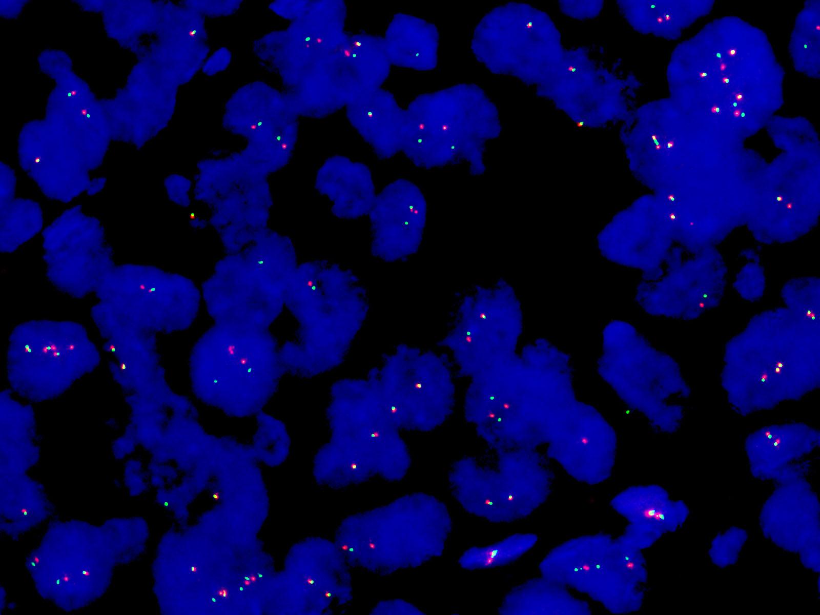 FP-051-b-EWSR1断裂阳
